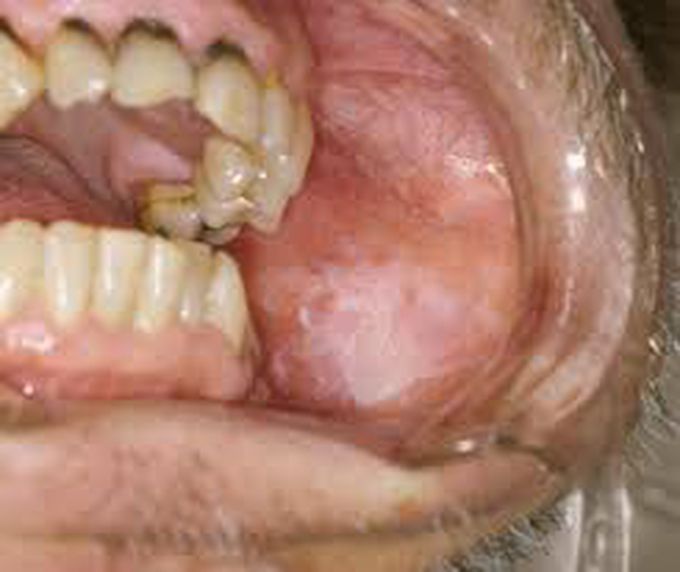 What is leukoplakia