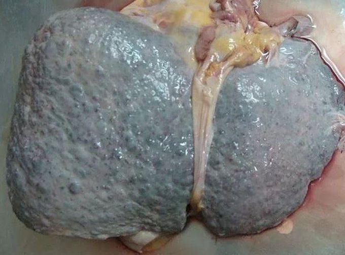 Presentation of liver cirrhosis