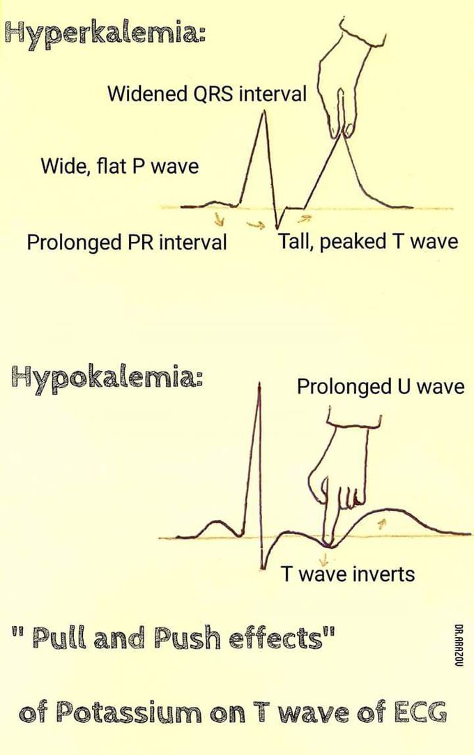 "Effects of potassium on T wave of ECG"