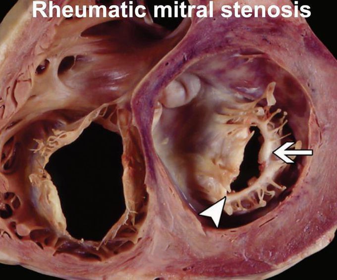 Rheumatic Mitral Stenosis