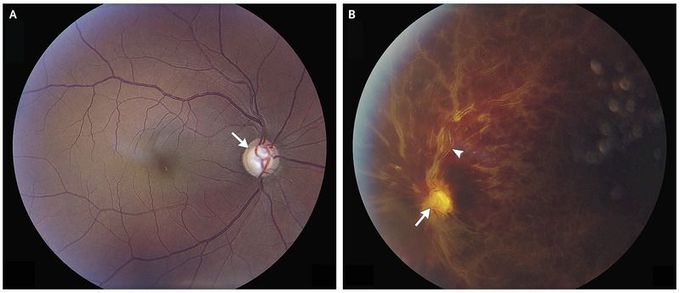 Central Retinal-Vein Occlusion