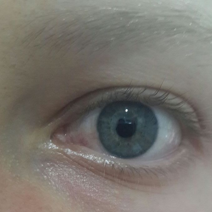 Whats wrong with this eye?