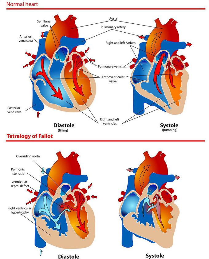 Healthy heart vs. Tetralogy of Fallot