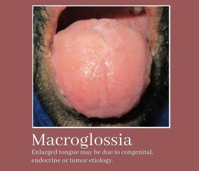 Macroglossia