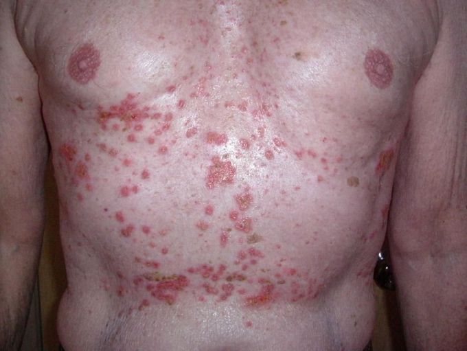 Transient Acantholytic Dermatosis aka Grover's Disease