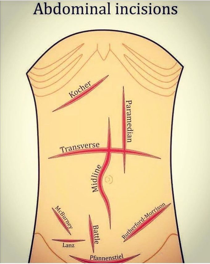 Abdominal incisions - MEDizzy