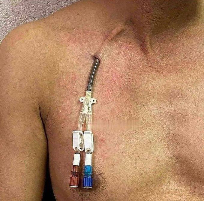 Hemodialysis catheter