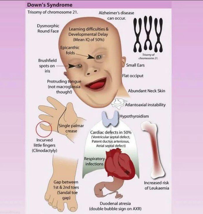 Down's Syndrome - MEDizzy