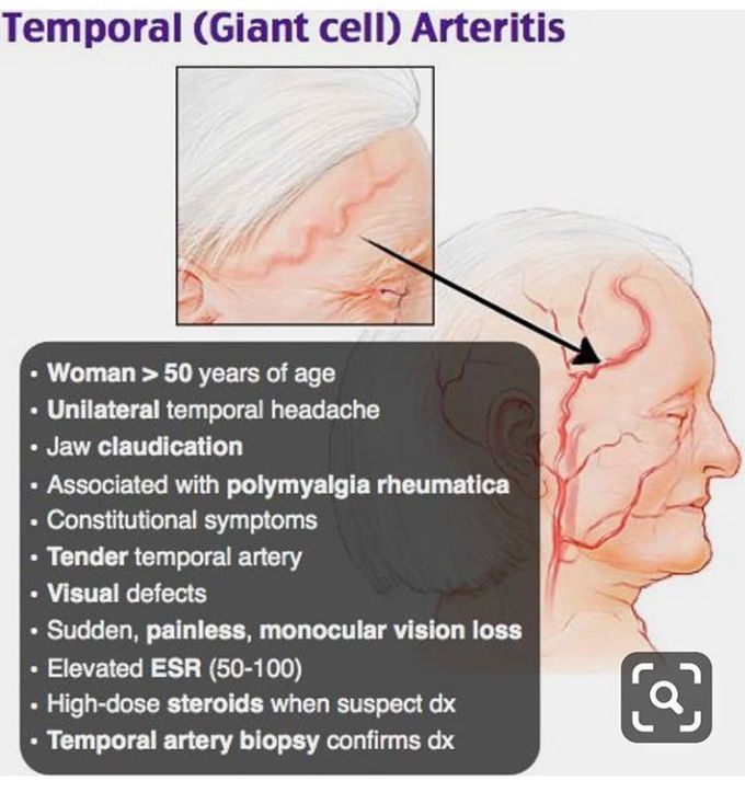 Temporal_artery