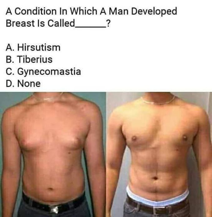 A condition in which a Man developed Breast .