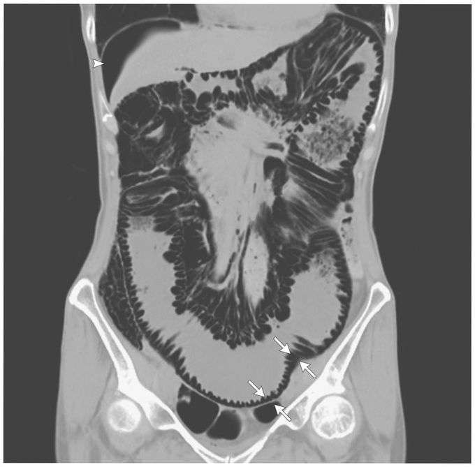 Pneumatosis Cystoides Intestinalis