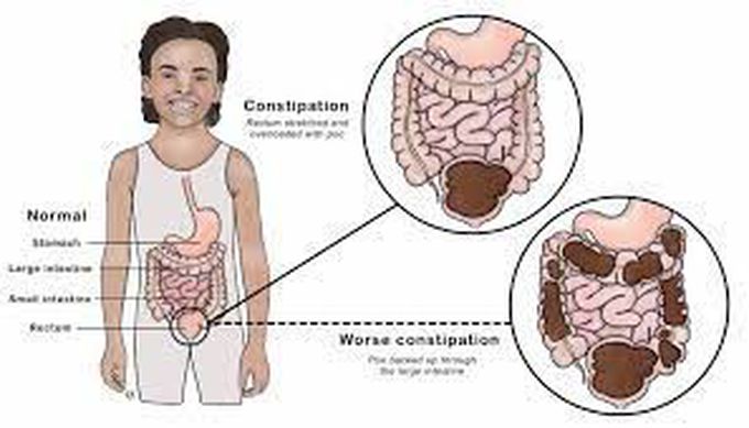 Causes of constipation