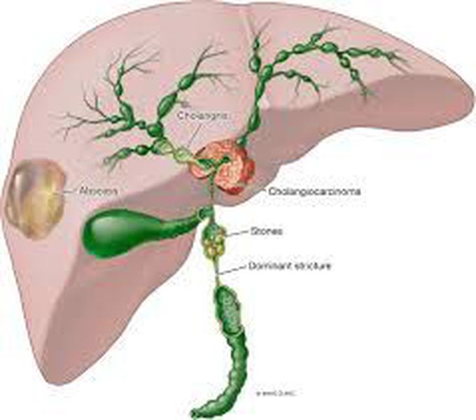 Sclerosing cholangitis