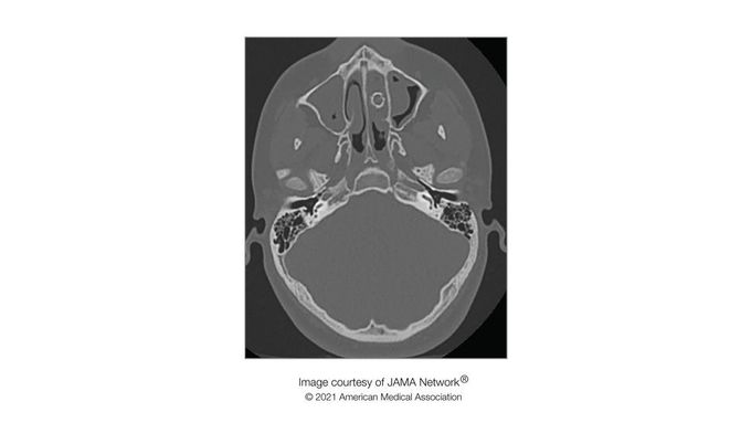 BB gun pellet lodged in teen's nose