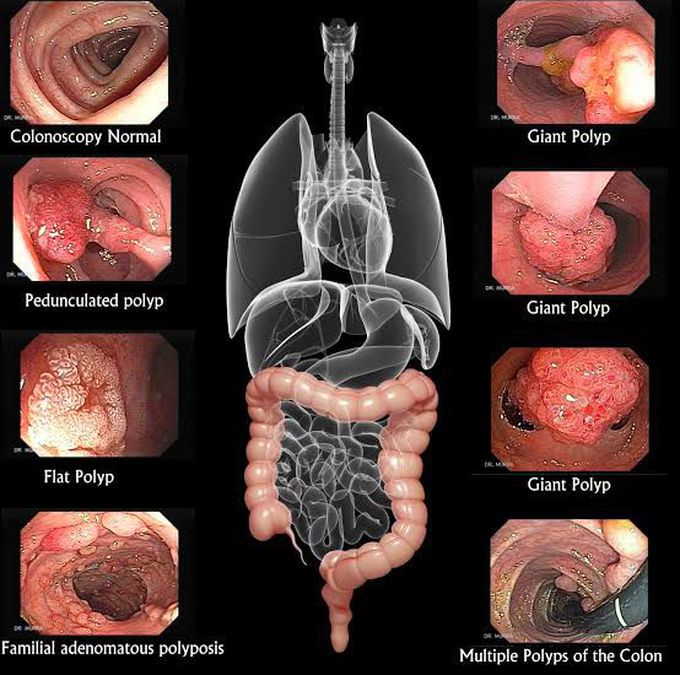 Polyps in the Large Intestine