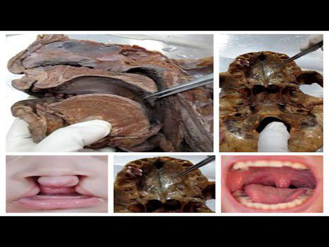 Hard and soft palate anatomy: Cadaveric examination