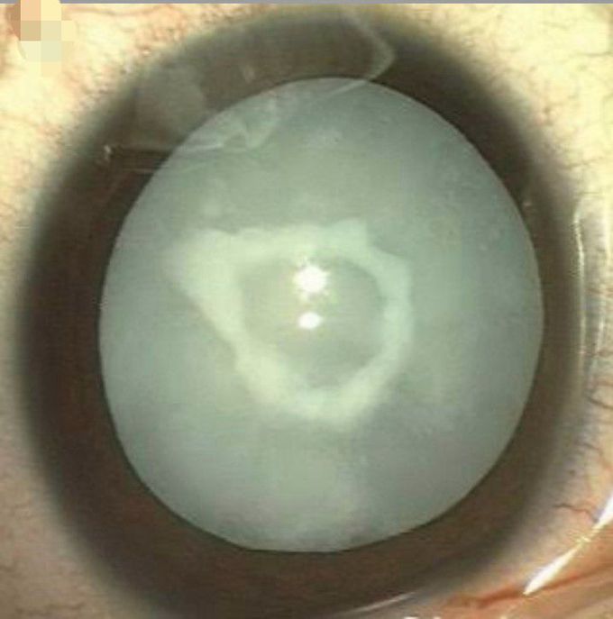 Diagnosis?Condition in which this type of cataract is seen? 