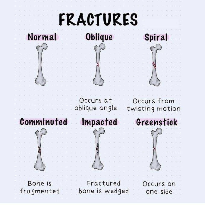 Fractures