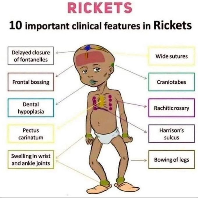 Rickets clinical features