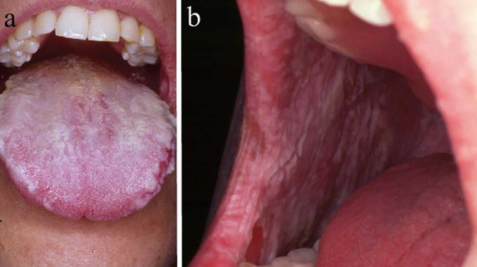 WHITE SPONGE NEVUS