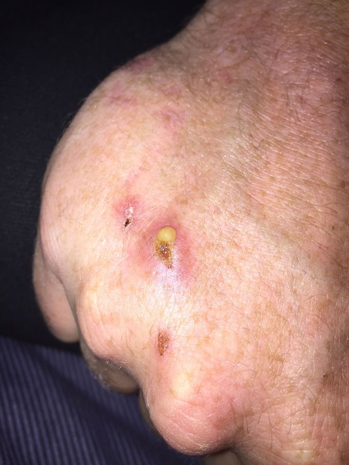 Infected hand