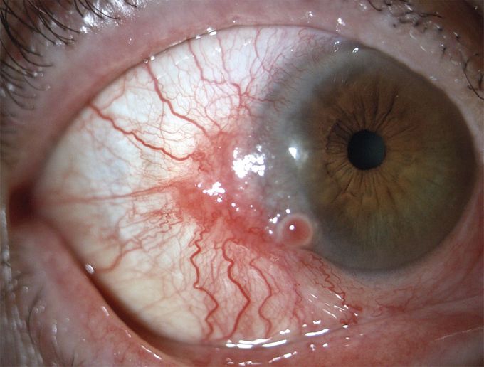 Conjunctival Squamous-Cell Carcinoma
