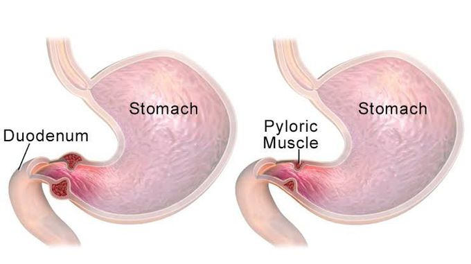 Pyeloric stenosis