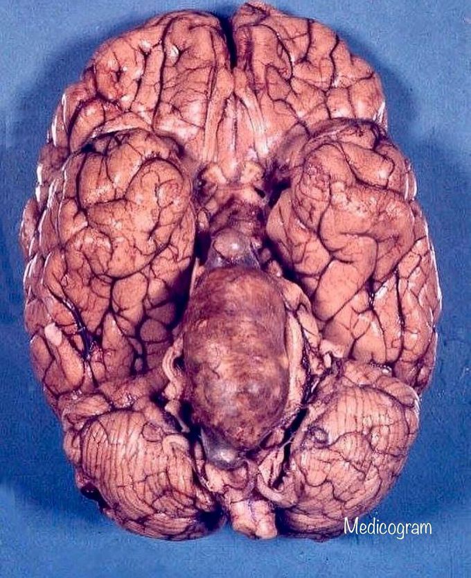 Atherosclerotic aneurysm of the basilar artery