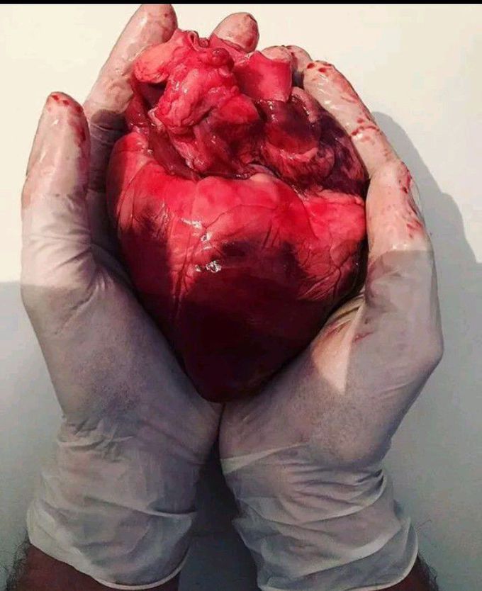 Heart Surgery