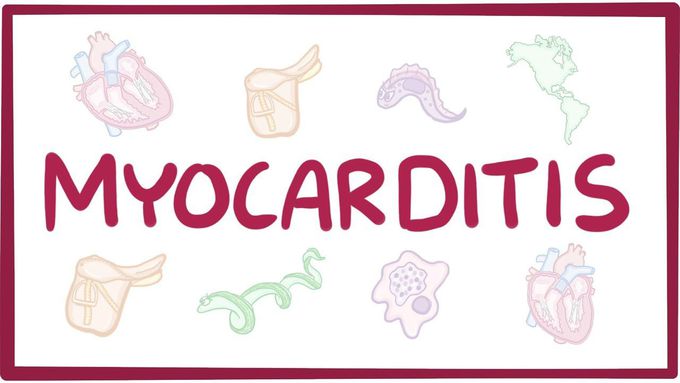 Myocarditis - causes, symptoms, diagnosis, treatment, pathology