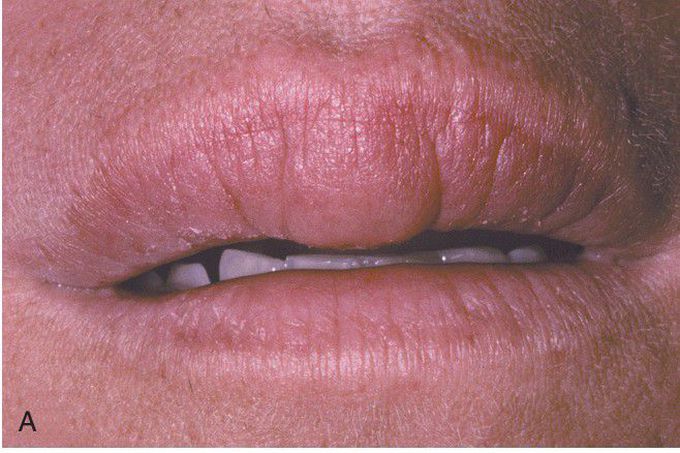 Orofacial Granulomatosis
