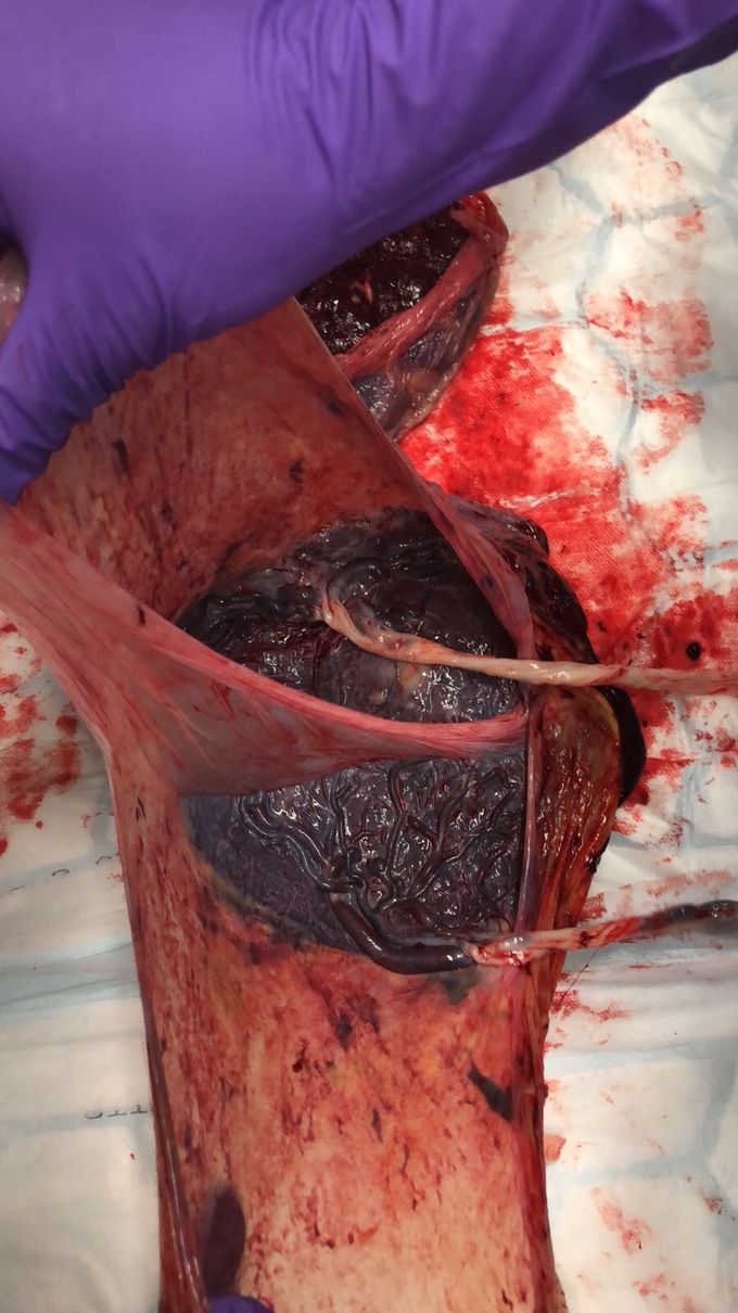 A gemini placenta!