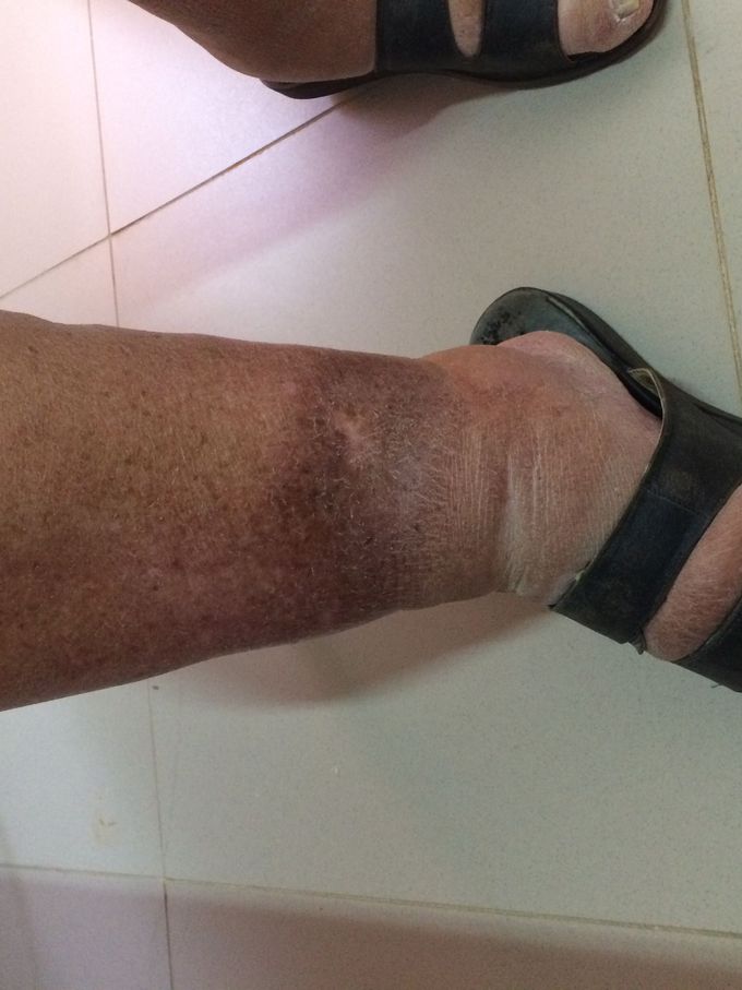 Edema