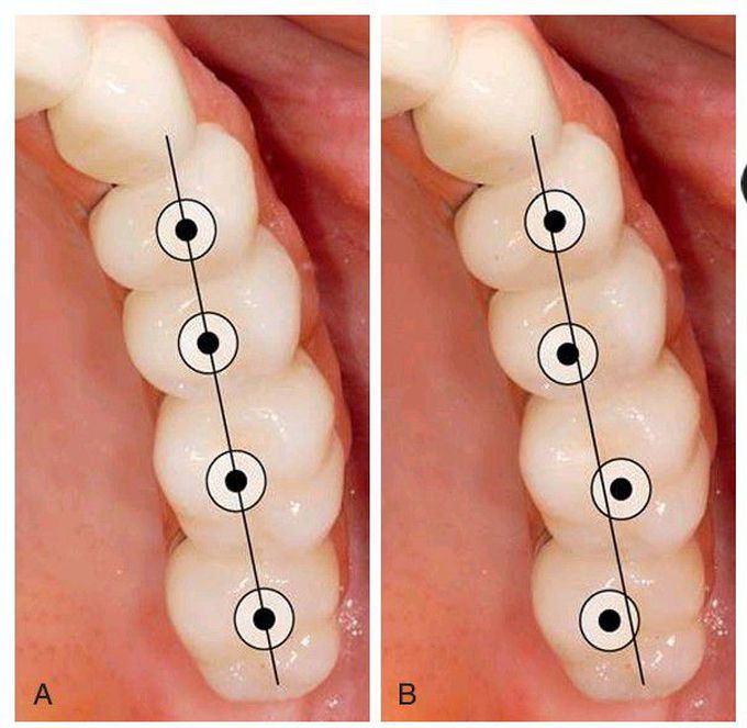 Placement of implants.