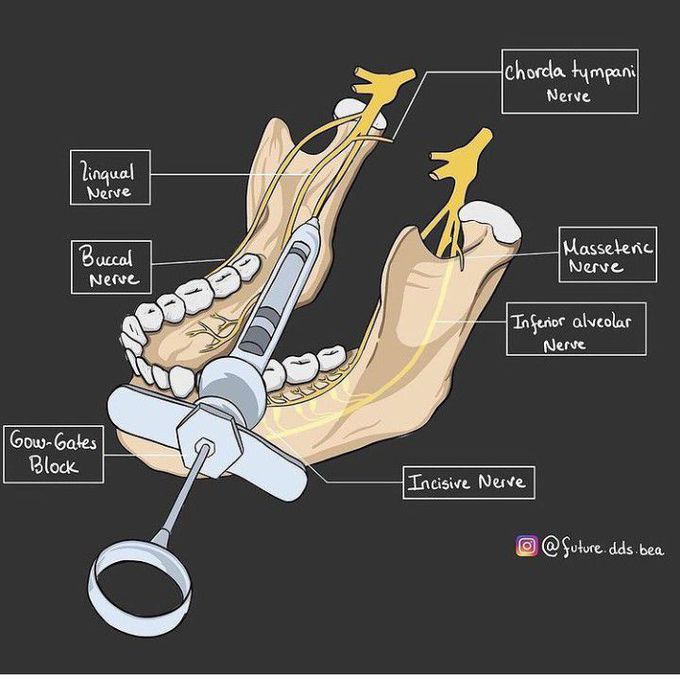Lingual nerve block