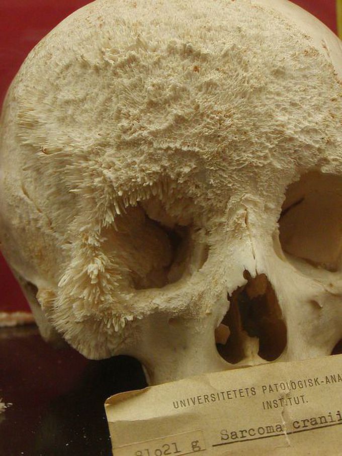Bone cancer on a human skull.