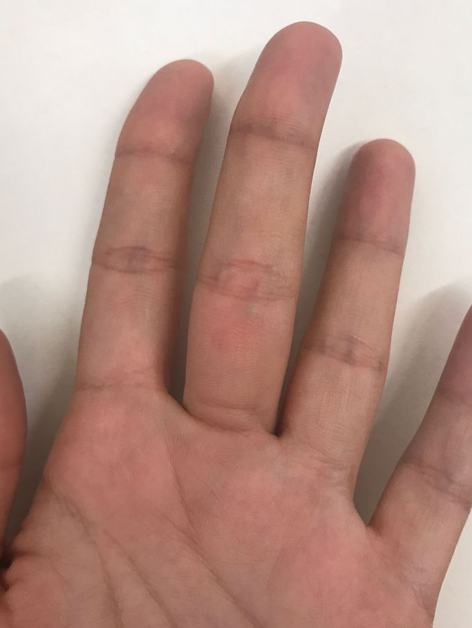 bump on finger