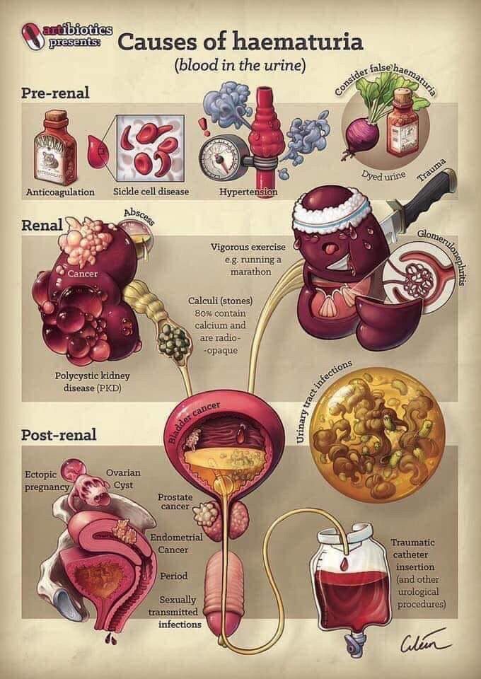 Cause of haematuria