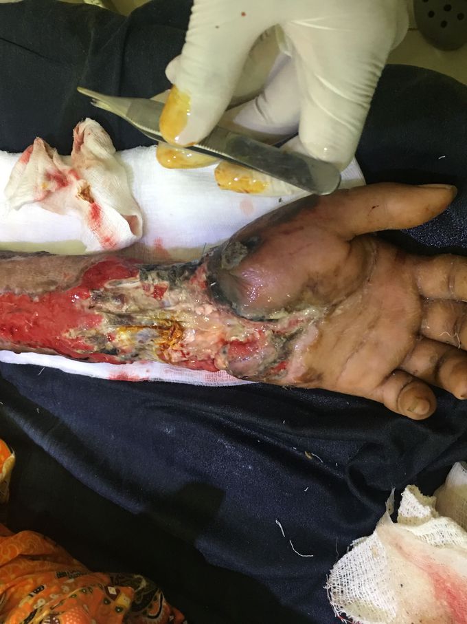 Electrical Burn