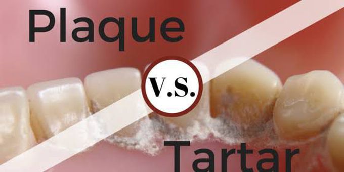Plaque Vs Tartar