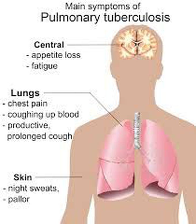 Symptoms of TB