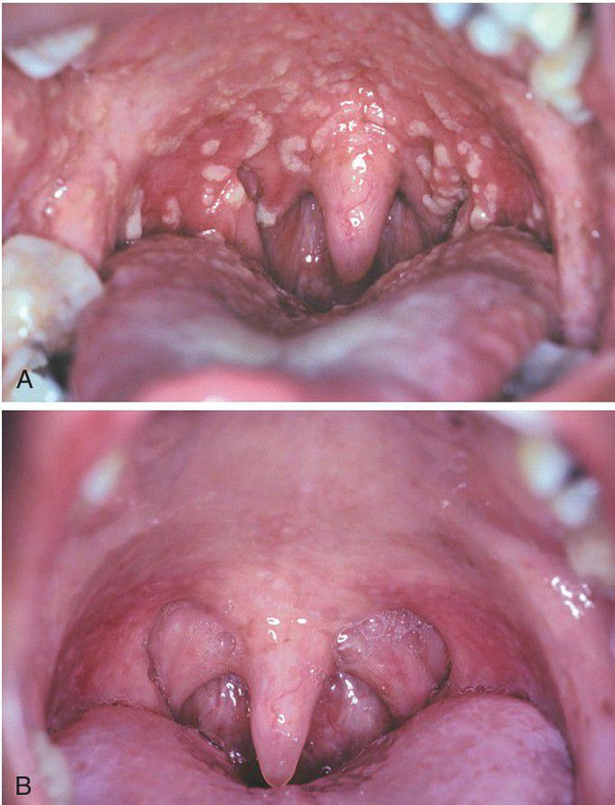 Pyostomatitis Vegetans.