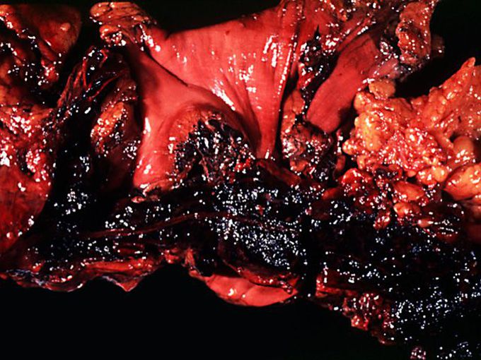 Causes of Acute Pancreatitis - A Mnemonic