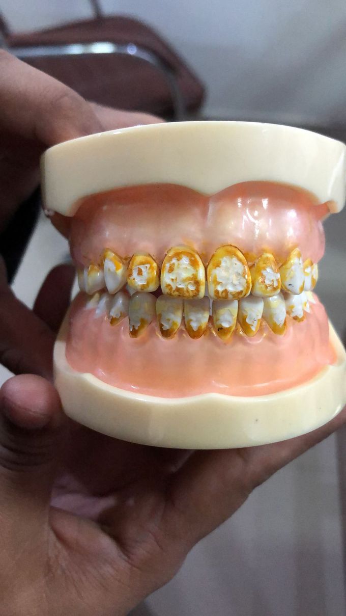 Dean's Fluorosis Index