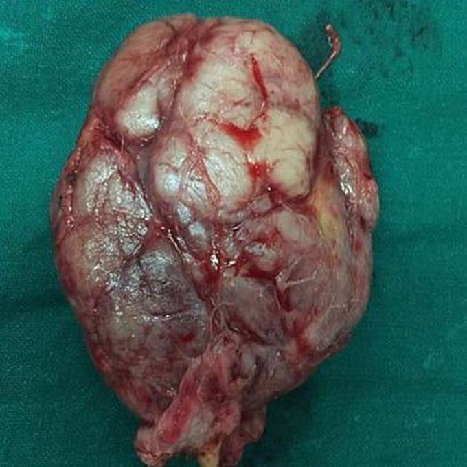 Gaint fibroadenoma breast cancer.