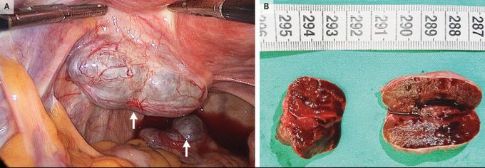 Pelvic Splenosis