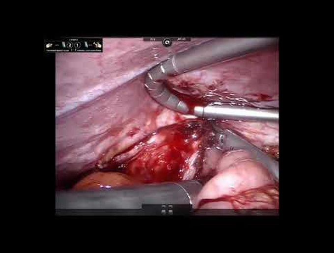 Robotic Repair of an Incarcerated Right-Sided Diaphragmatic Hernia After Liver Resection