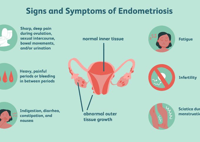 Symptoms of Endometriosis - MEDizzy