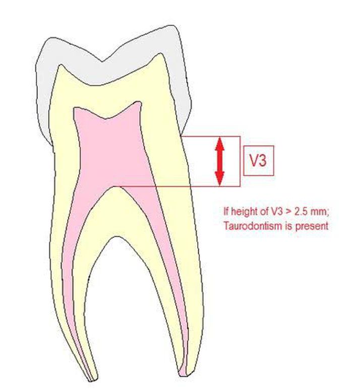 Causes of taurodontism