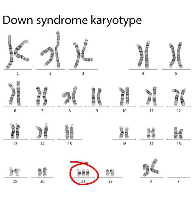 down syndrome karyotype